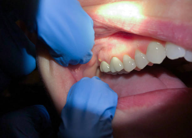 Best Emergency Root Canal Treatment in Sycamore, IL